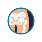 Hip pain